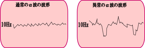 通常のアルファ波の波形・異常のアルファ波の波形